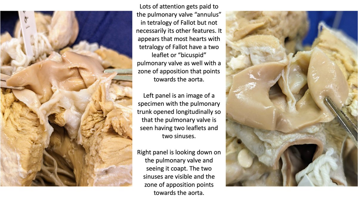 Two-leaflet pulmonary valve in tetralogy of Fallot. 

More specimen based teaching... a.co/d/ee9drWX

#morphology #CHD #anatomy #pathology #pediatrics #pedsicu #pedscards #pedscicu #MedTwitter #cardiology #pediatriccardiology #medicine #anatomia #cardiacsurgery #surgery
