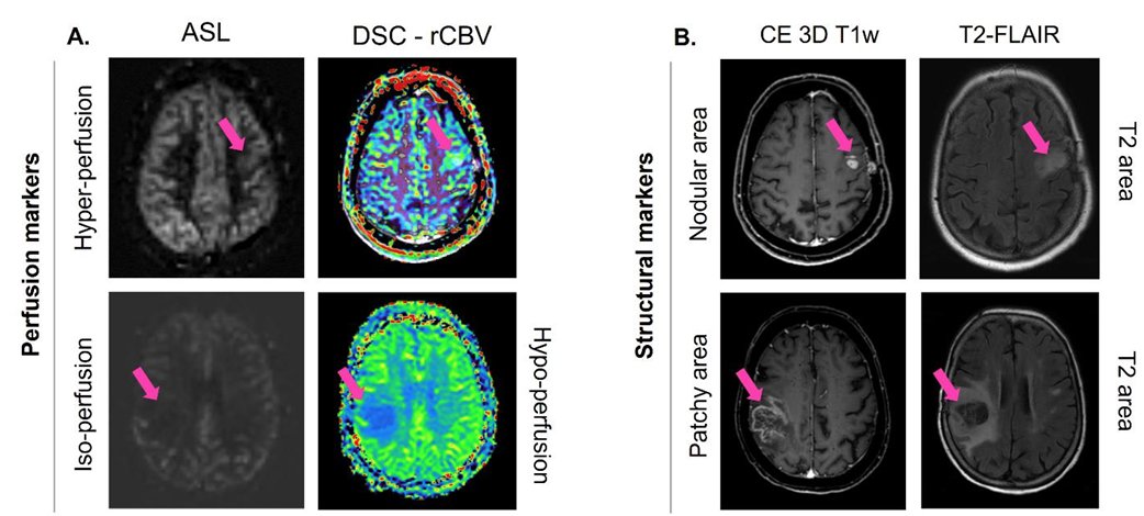 NeuroOnc's tweet photo. MRI phenotypes of glioblastomas early after treatment are suggestive of overall patient survival 
https://t.co/0wdXmLYlMd https://t.co/uyN8BFkdIp