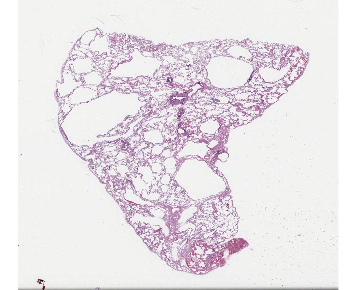 Path4People's tweet image. 30 y/o Female with PMHx of “asthma”

Has had worsening exertional dyspnea the past couple of months.

She’s had a prior history of pneumothorax as a teen.

What is the Dx and associated syndrome? 

Path Slide credit: @UMichPath 
#pathagonia #pathx #pulm #genetics #medx