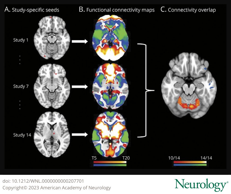 GreenJournal's tweet photo. This study's findings suggest that the cerebellum is the central hub of a network commonly connected to structural and metabolic abnormalities in essential tremor: https://t.co/XJjuqmMP0X

#NeuroTwitter https://t.co/8gJdZJTFSD