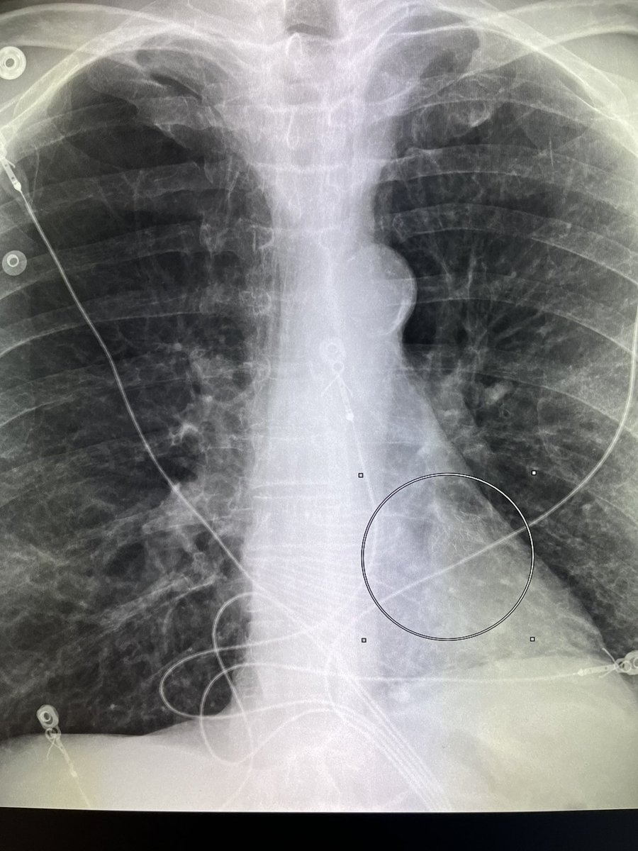Look closely !! What is expected as left atrial occlusion device is actually is “endobronchial valves “ be careful do not generalize. #radres
#radiology