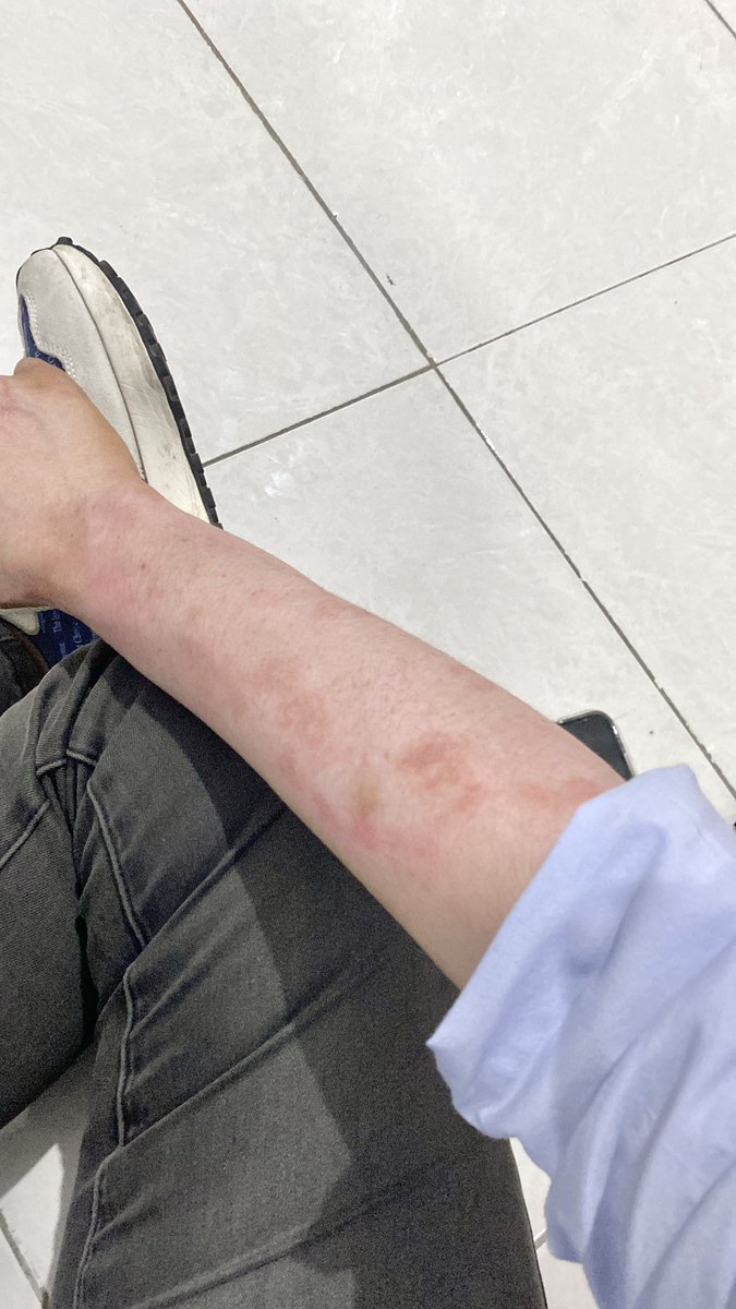 Udh berobat kemana pun ngilangin merah ditangan susah banget karna  efek cuaca yg xtream gni pdhal udh pke sunblok🥺