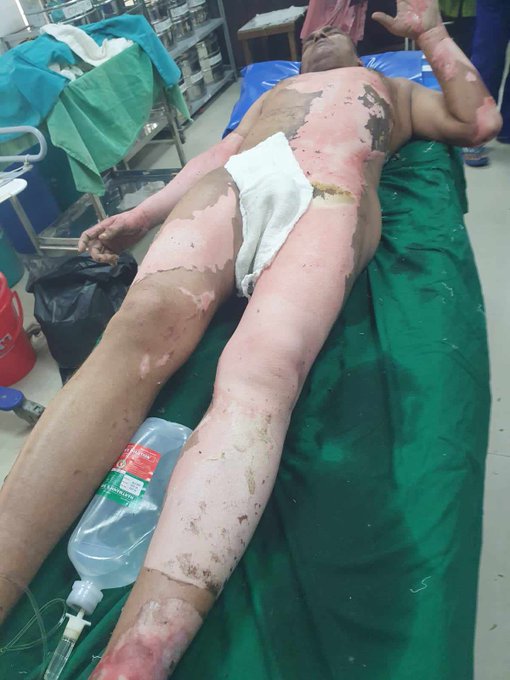 টাঙ্গাইলে ট্রান্সফরমার বিস্ফোরণে পুলিশের এসআই দগ্ধ