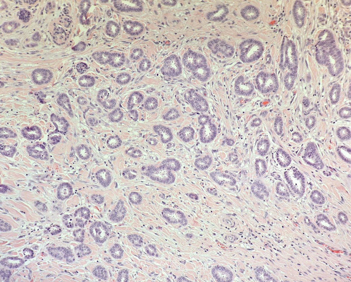 #TubularCarcinoma 
Nice example. 
Spot those apical snouts 😉
#pathology 
#BreastPath
#PathTwitter