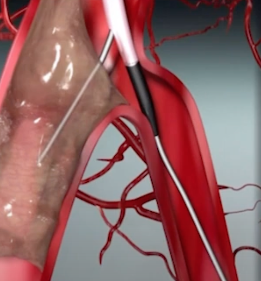 HadyLichaaMD's tweet image. 1/4 
#CathTIPs

#MultiLumenMicroCatheters: Where and How?

youtu.be/Rp5QaqirHUU?si…

No COI

@FadiGhrairMD, @TWilsonMD, @hadi_khachab7, @MadhuraMyla, @Cathdoctor, @CMosarla, @sorabh_kothari, @fangjonathanx, @BakhshiHooman, @heartAPalomo, @incathlab @Doctorpedia_ @CardioNerds