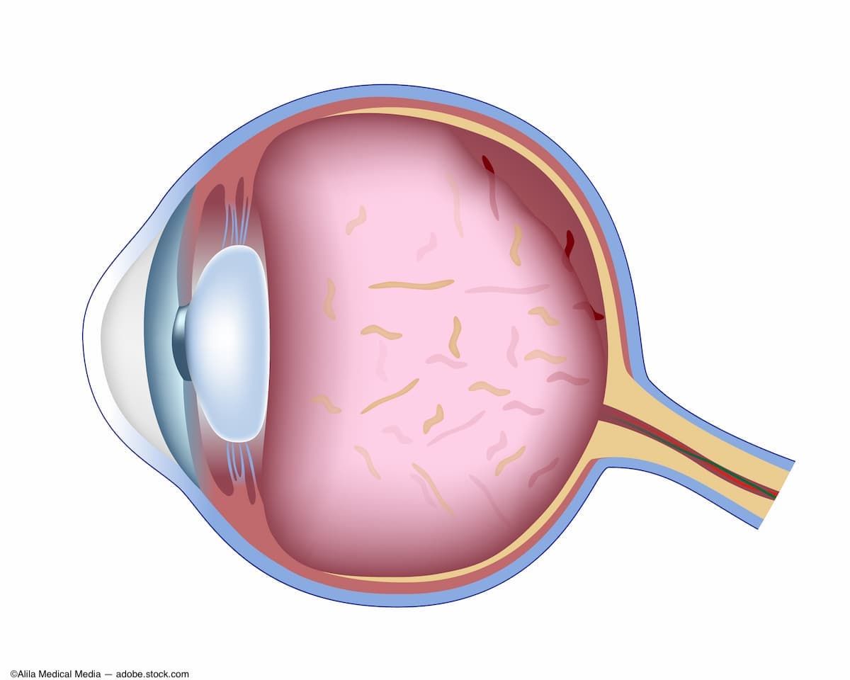 The authors of a case series say silicone oil droplets from silicone used to lubricate the McKesson syringes is the most likely cause of the droplets presumed to cause the floaters.

Read more: modernretina.com/view/case-seri…