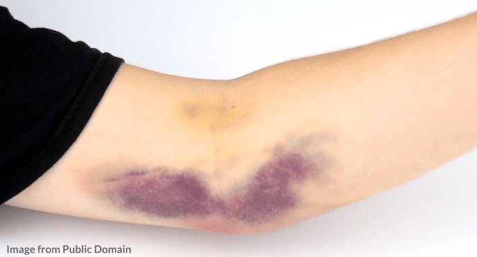 AliMedic_'s tweet photo. Hematoma
هذي الحاله الهيماتوما. تحدث لما اللي يركب لك الابره يدخل الوريد من جهه ويكمل يطلع من الجهه الثانيه، بعدها بيكون الوريد مفتوح من الجهتين فيتسرب دم حول منطقه الحقن وتصير بهذا الشكل. او حتى يكون في اورده صغيره جدا ماتبين فتصاب خلال تركيب الابره. الصور وحده يدي والثانيه قوقل https://t.co/YVoLPnToIP