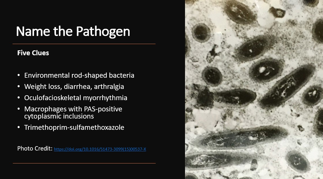 MayoClinicINFD's tweet photo. Weekend Digest

Name the Pathogen

Five Clues:
1. Environmental rod-shaped bacteria
2. Weight loss, diarrhea, arthralgia
3. Oculofacioskeletal myorrhythmia
4. Macrophages with PAS+ cytoplasmic inclusions
5. Trimethoprim-sulfamethoxazole https://t.co/pGHELzWrAZ