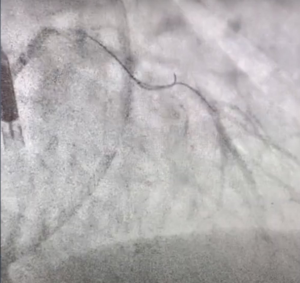 HadyLichaaMD's tweet image. 1/4 
#CathTIPs

#MultiLumenMicroCatheters: Where and How?

youtu.be/Rp5QaqirHUU?si…

No COI

@FadiGhrairMD, @TWilsonMD, @hadi_khachab7, @MadhuraMyla, @Cathdoctor, @CMosarla, @sorabh_kothari, @fangjonathanx, @BakhshiHooman, @heartAPalomo, @incathlab @Doctorpedia_ @CardioNerds