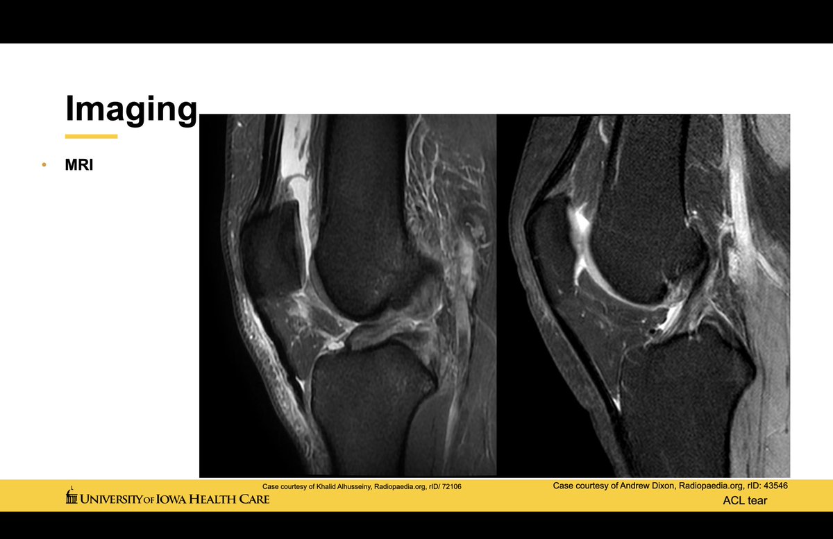 BrunoButturi's tweet photo. Anterior Cruciate Ligament Reconstruction.
Speaking to a highly selected audience here at the
@uiowa
Surrounded by technical DETAILS and care.
This surgery is, in my point of view, a true ART...
Countless variables make the procedure unique and complex. https://t.co/H2a6fJmdme