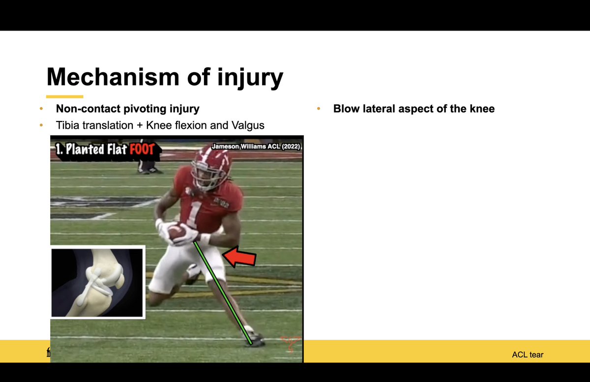 BrunoButturi's tweet photo. Anterior Cruciate Ligament Reconstruction.
Speaking to a highly selected audience here at the
@uiowa
Surrounded by technical DETAILS and care.
This surgery is, in my point of view, a true ART...
Countless variables make the procedure unique and complex. https://t.co/H2a6fJmdme