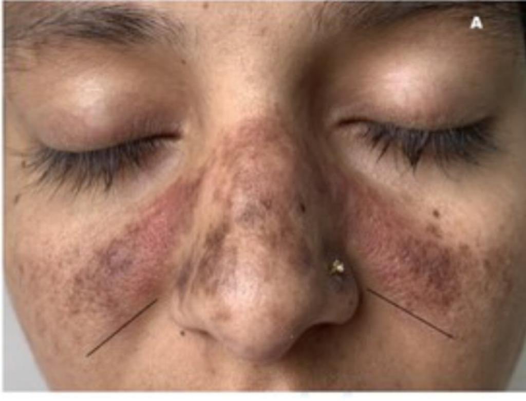 JasmineNephro's tweet photo. 🦋🦋Not every malar rash is due to lupus
✅Lupus Malar rash spares nasolabial fold (arrow👇)
🤩Other differentials
💡Rosacea-Central face/telangiectasia✅
💡Dermatomyositis
💡Pellagra
💡Seborrheic dermatitis
💡Melasma/Sunburn
📸#QJM #MedX https://t.co/Ud6EoTiCss