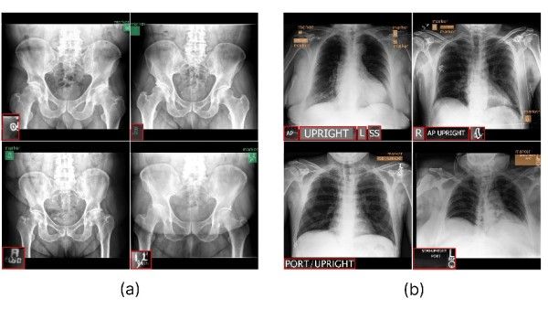 <a href="/Mayo_OSAIL/">MayoOSAIL</a> <a href="/MayoRadiology/">Mayo Clinic Radiology</a> model accurately and selectively removes radiographic markers doi.org/10.1148/ryai.2… <a href="/CodyWylesMD/">Cody Wyles</a> #deidentification #AI #MachineLearning