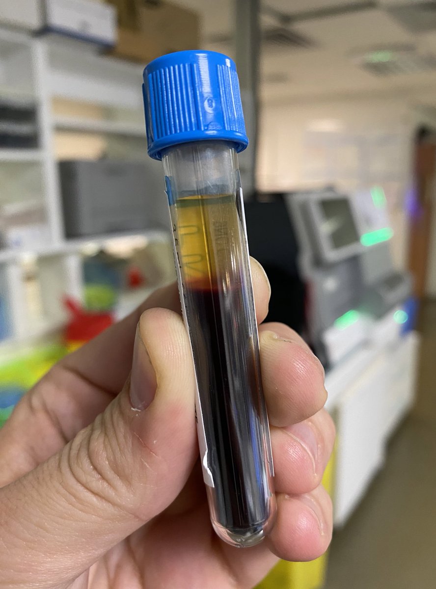 GendronNico's tweet photo. ❤️🩹Cardiopathie congénitale et hématocrite à 67%🩸
#LTGarde https://t.co/pj0zq0BCs4