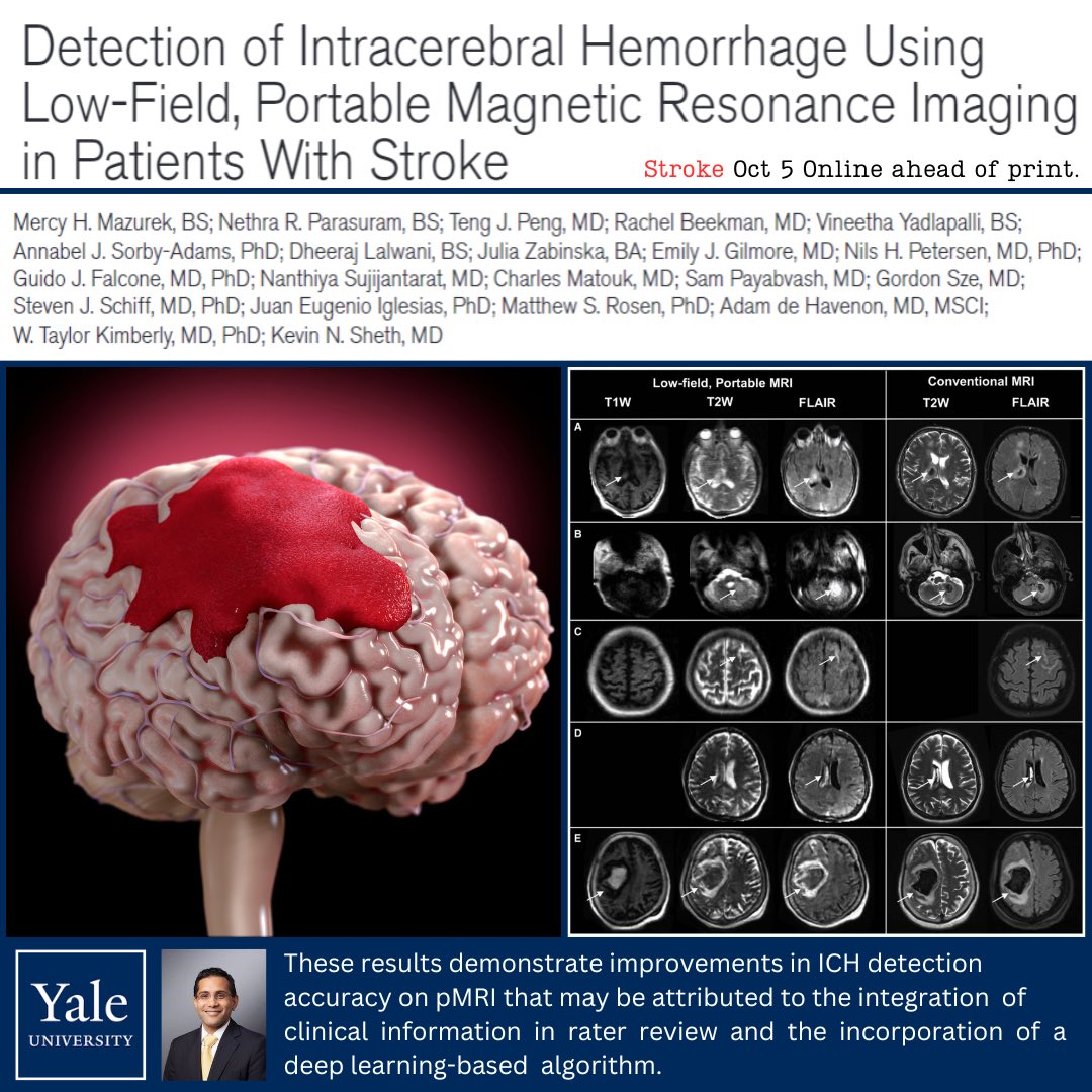 Great work from Kevin Sheth's lab exploring the integration of clinical information and a deep learning algorithm on intracerebral hemorrhage (ICH) detection using the Swoop Portable MR Imaging System (Hyperfine). Beautiful work from the wards of Yale-New Haven Hospital ...