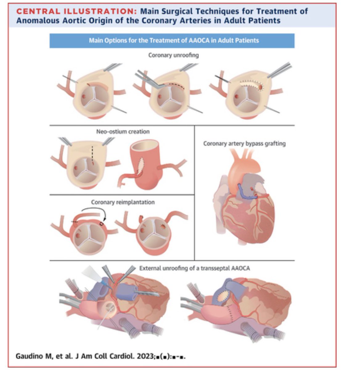 🔥 Hot off the press🔥 Management of Adults With Anomalous Aortic Origin of the Coronary Arteries in @annalsthorsurg & @JACCJournals Really enjoyed contributing to this! @AntoninoDiFran1 @emilebachamd @SVRaoMD @ColumbiaSurgery Check it out 👉 jacc.org/doi/full/10.10…
