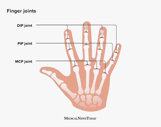 InjuryExplained's tweet photo. That’s most likely a distal phalanx fracture in #ReeceTopley’s left index finger. The DIP joint could be involved. This will rule him out of the #ICCCricketWorldCup23 once confirmed #EnglandCricket @TheBarmyArmy https://t.co/7IlSaqwzoO
