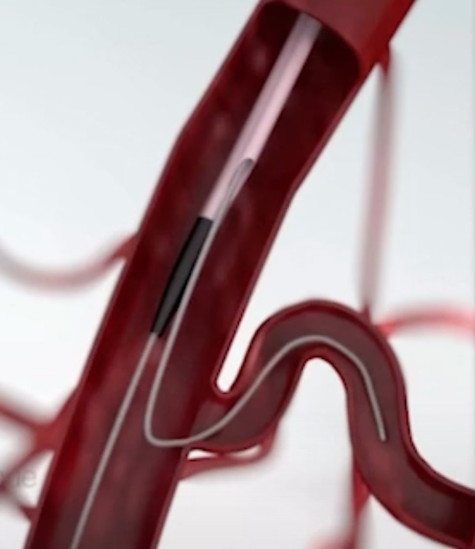 HadyLichaaMD's tweet photo. 4/4
#ReverseWiring of #RetroflexBranches with #DLC
@DrJayMohan @mw_sherwood @_backtable @sahilparikhmd @DrMauricioCohen @GoranEBC @twj1974 @nolanjimradial @TheNarulaSeries @Murmur_MD @brownc_12 @MatthiesenTimm @jefftylermd @vascularIR @kmadass @LessneVIR https://t.co/vTVFr51pa9