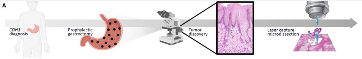 MCR_AACR's tweet image. #ICYMI:
Early immune changes support signet ring cell #dormancy in CDH1-driven hereditary diffuse gastric #carcinogenesis, by Green, @JeremyLDavisMD et al.
bit.ly/45Eiknm
@LaurenGambleMD @stephielux_ @mbyaffe @theNCI @kochinstitute @MIT #HDGC #GastricCancer