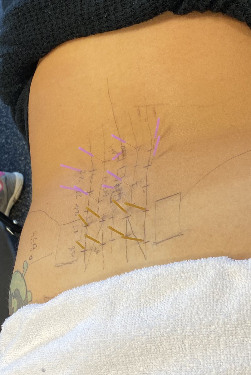 DrB_Forbes's tweet photo. Day 2 of DN-2 in Charlotte, NC is underway! Over 30 driven clinicians leaning highly skilled Dry Needling techniques to optimize their patient care and outcomes!
#AAMT #Osteopractor #DryNeedlingInstitute #CertDN #BestEvidenceBestPractice
@Osteopractor @PaulBliton @PatrickGorby https://t.co/M51xRjSMy7