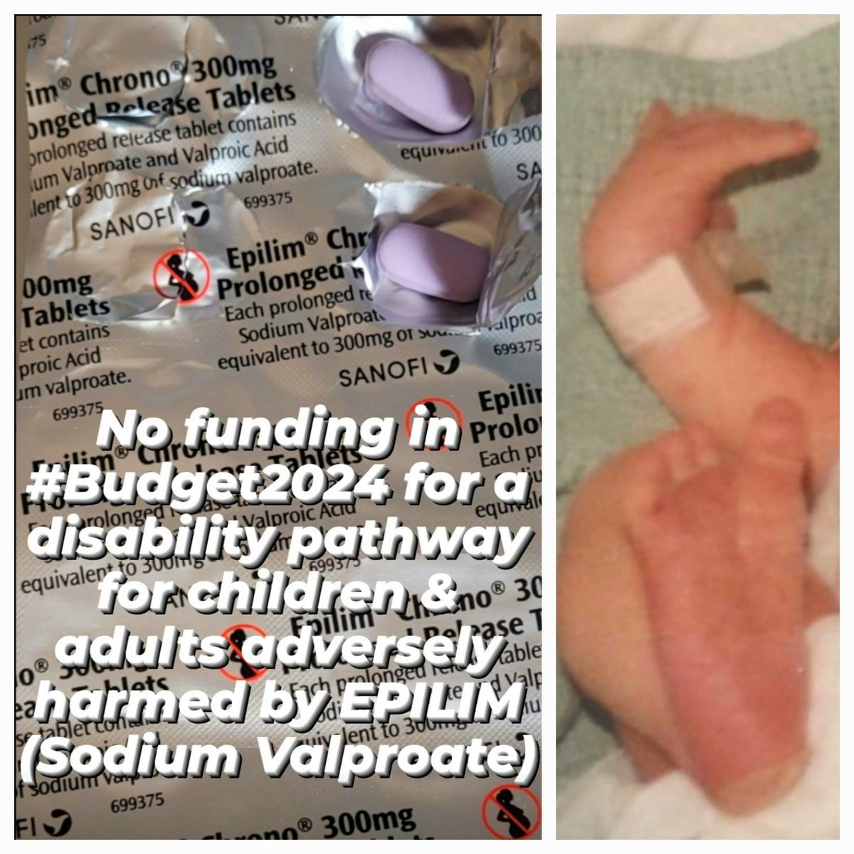 oacsireland's tweet photo. @roinnslainte @DonnellyStephen
@AnneRabbitte @LeoVaradkar 
We want a Full #Disability Pathway in place for #Irish children &amp; adults #adversely harmed by #Epilim Sodium #Valproate.All harm done was #Foreseeable, #Preventable, 
#Reportable the Irish gov now needs to be accountable https://t.co/80TF292H7n