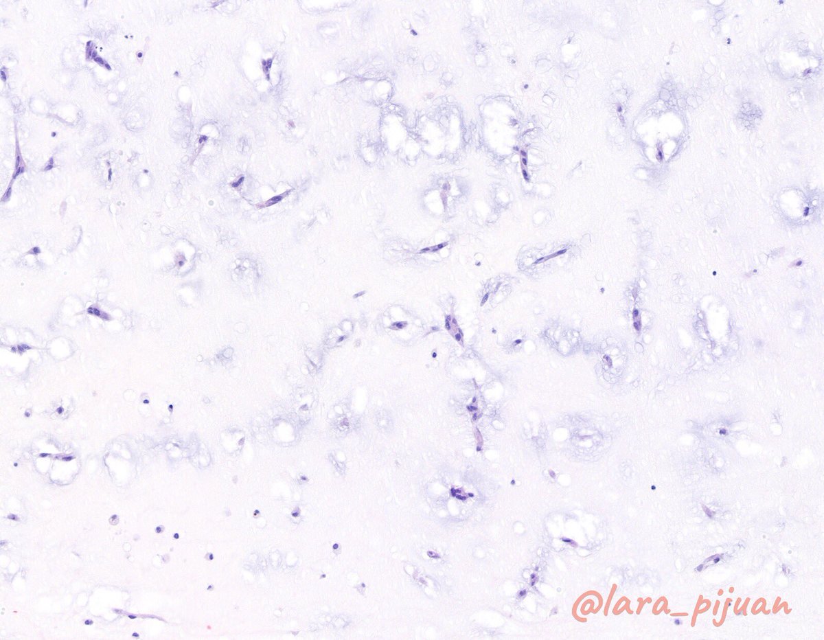 Left Atrial #Myxoma: 
❤️ Most common primary tumor of heart. 
🔬Hypocellular myxoid stroma with perivascular and dispersed scattered spindle-shaped cells.
#CVpath
#Bellvitgepath #orgullbellvitge