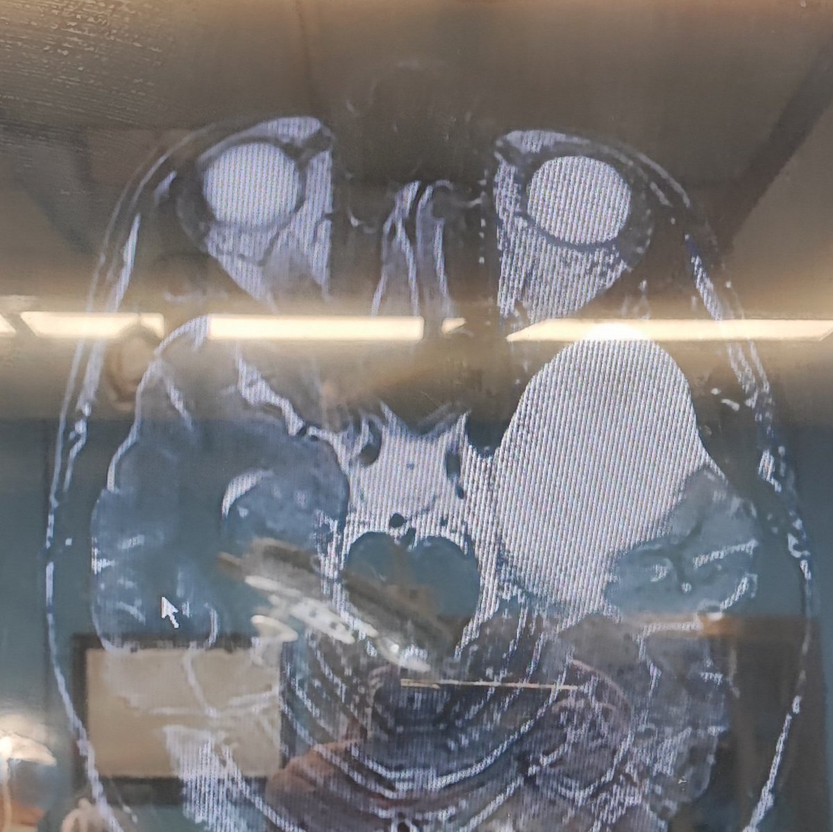 mo_ma1374's tweet photo. Today, a 20-y/o man, who presented with headache after a slight trauma to  head, underwent fenestration surgery with diagnosis of ruptured arachnoid cyst, thanks to dear Dr. Rakhsha... https://t.co/tu1Ifszgcs