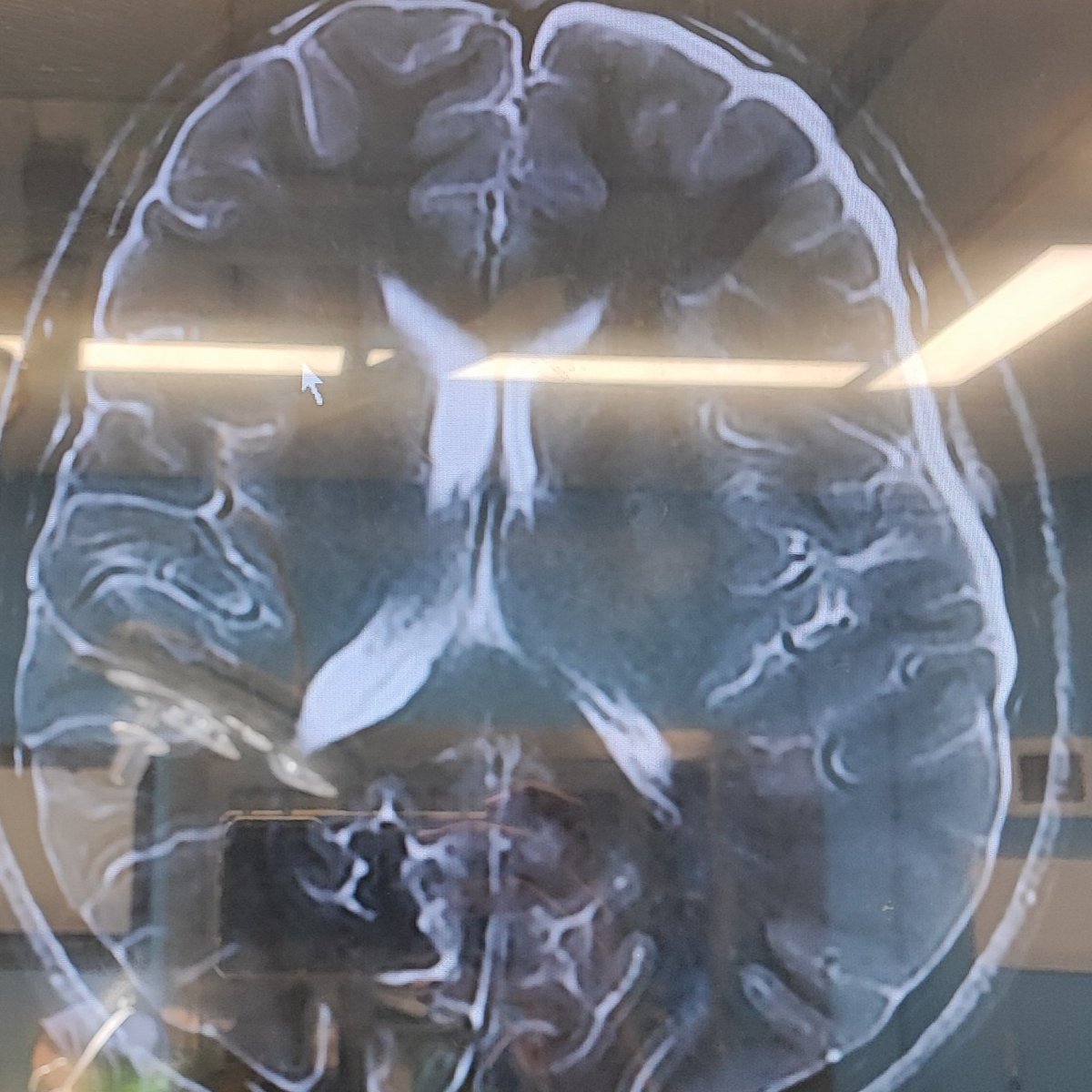 mo_ma1374's tweet photo. Today, a 20-y/o man, who presented with headache after a slight trauma to  head, underwent fenestration surgery with diagnosis of ruptured arachnoid cyst, thanks to dear Dr. Rakhsha... https://t.co/tu1Ifszgcs