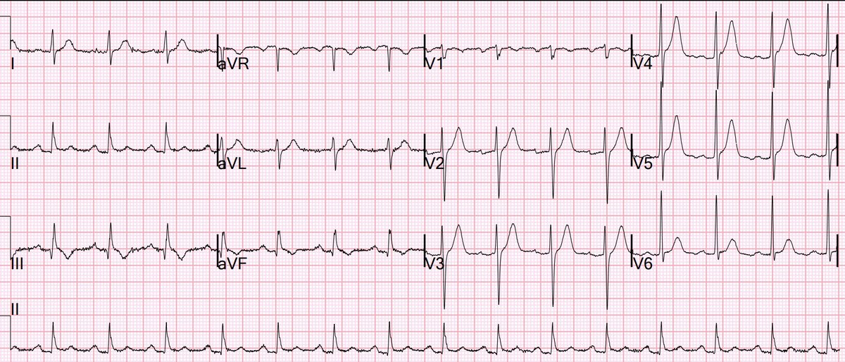 smithECGBlog's tweet photo. This ECG was texted to me after the fact with no information. What do you think?

https://t.co/XtIV67acgy https://t.co/OwRPUk3VQc