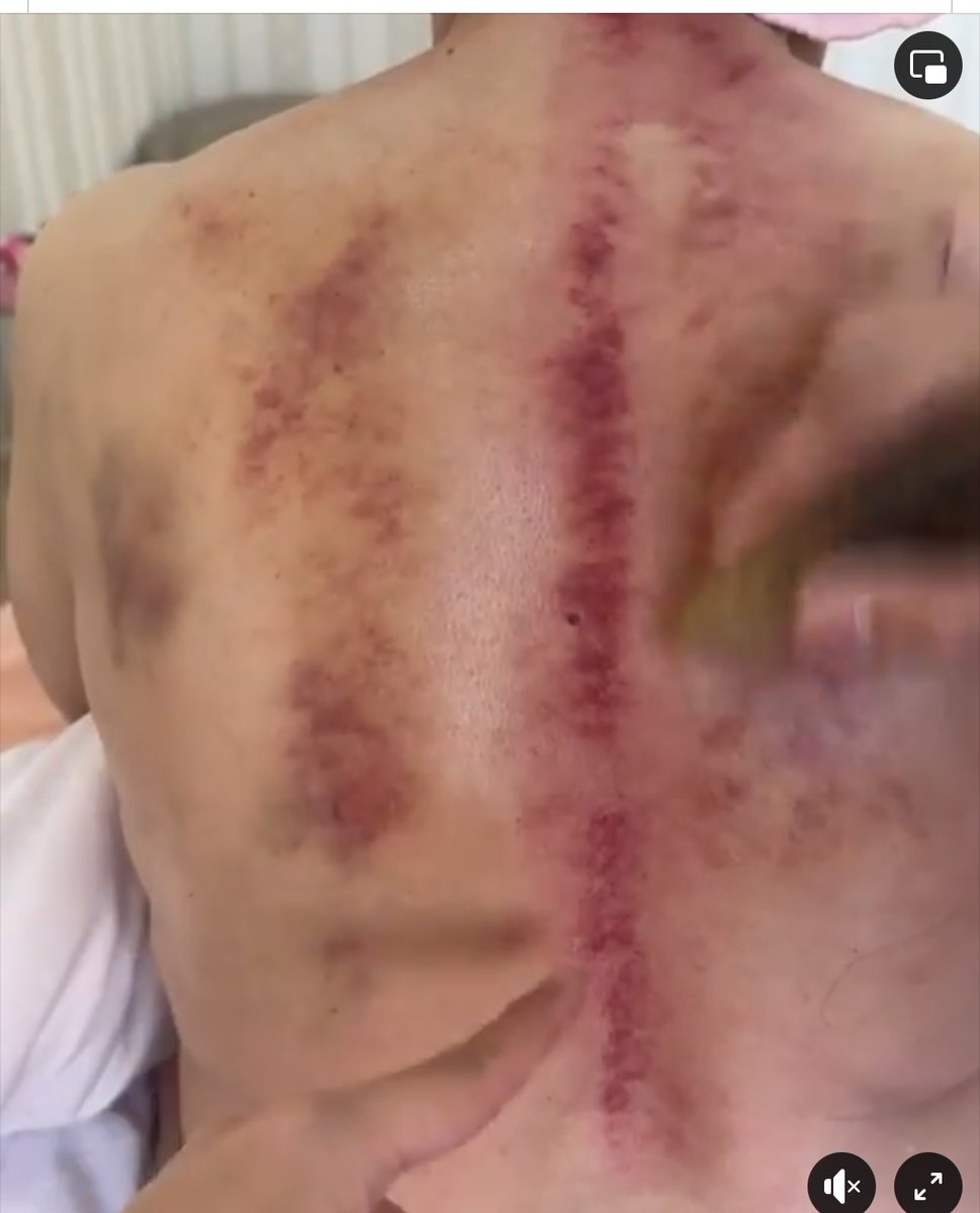 Гуаша маша гээд хэдэн жижиг хялгасан бичил судсыг нь гэмтээж хагалж зовоож эмчлэнэ ч гэж юу байхээ зүгээр🥺🤦🏻‍♀️