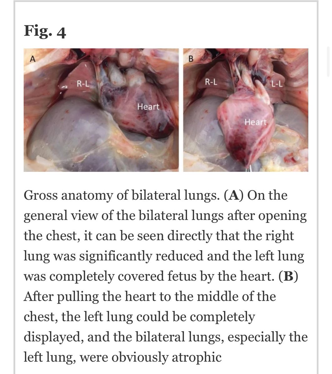 VirologyW's tweet photo. تقرير لحالة نادرة لإمراة أصيبت بكوفيد أثناء الحمل، حيث انتقل الفيروس من خلال الرحم للجنين وتسبب بأضرار في الدماغ والكبد والرئتين. طلبت المرأة إجهاض الجنين، وعند تشريحه وجدوا هناك ضمور واضح في الرئتين.

المرجع:

https://t.co/s69QHk0Akn https://t.co/SLAjTkg5YE