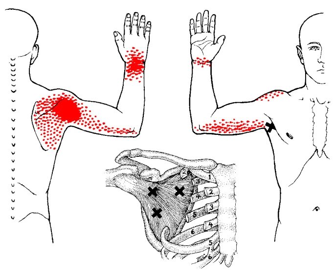 Referred pain pattern (red) from rotator cuff muscles:

▪️supraspinatus
▪️infraspinatus 
▪️teres minor 
▪️subscapularis

#pain #shoulder #rotatorcuff 
bmcmedicine.biomedcentral.com/articles/10.11…