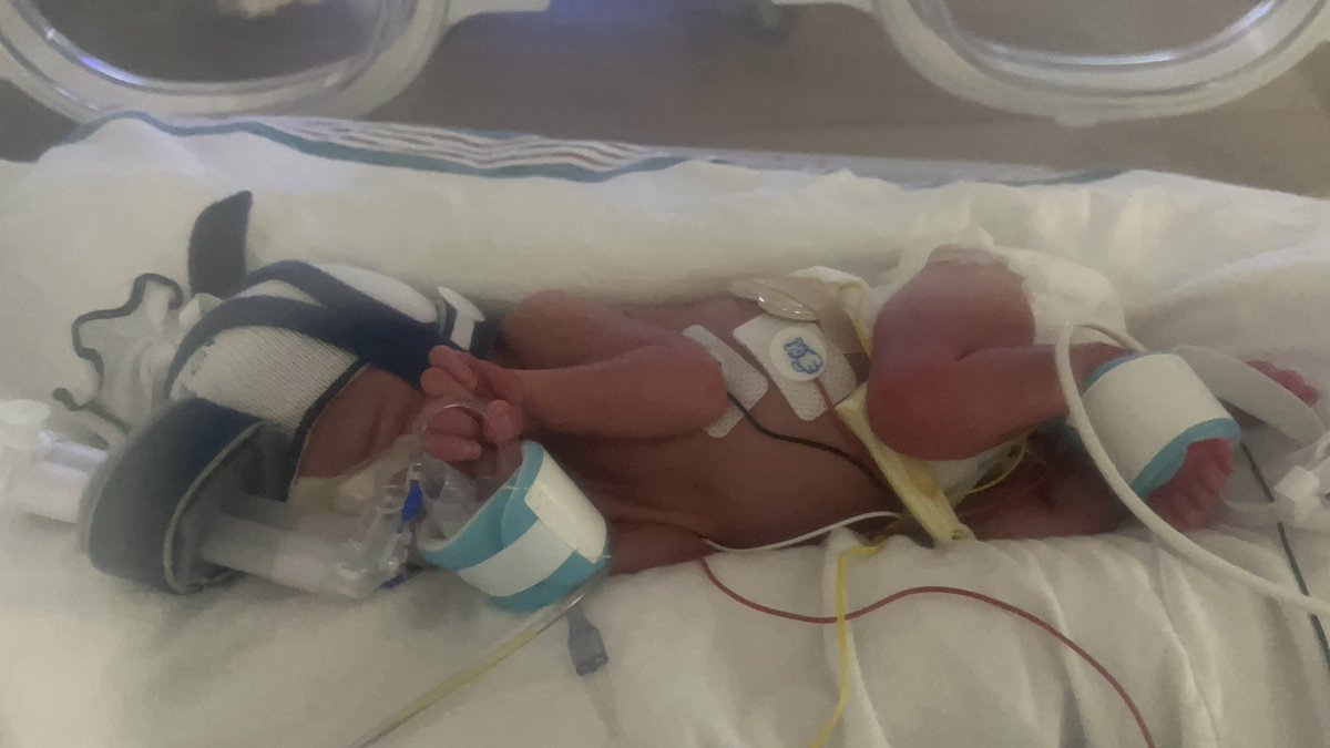 ItsDryy_'s tweet photo. So I don’t post on twitter at all anymore and most of you who followed me at some point in time probably don’t know who I am anymore but on October 9th I became a dad. Little Charlotte was born at only 29 weeks and weighed in at 2.7 pounds. https://t.co/sZgYR2zlbi