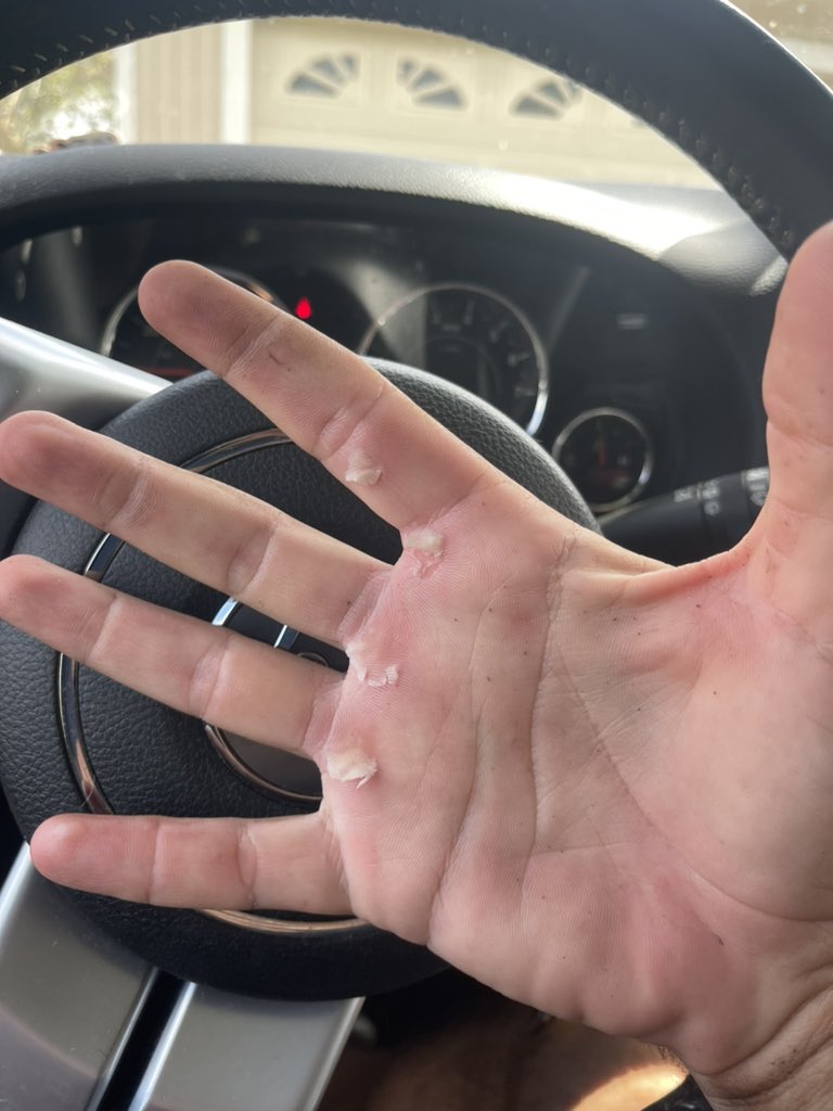 OffCourseNomad's tweet image. Any suggestions from my gym folk? Hurts to even wash my hands.