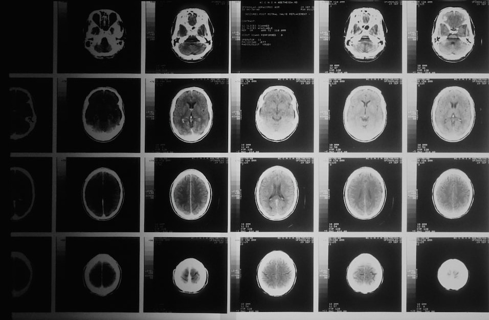 Howell_Allen1's tweet photo. Neurosurgery covers procedures on the nervous system, including the brain, neck, and spine. Neurologists and neurosurgeons collaborate for diagnosis and treatment. Minimally invasive options with small incisions are available, while complex cases may require advanced technology. https://t.co/Go1maccrf3