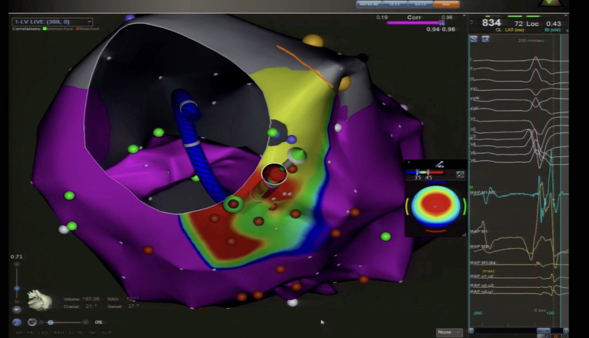 NUVISION Nav built on CARTOSOUND platform - has the ability to create the anatomy contouring in biplane, multiplane and 4D volume views. @VTSymposium @BiosenseWebster #epeeps