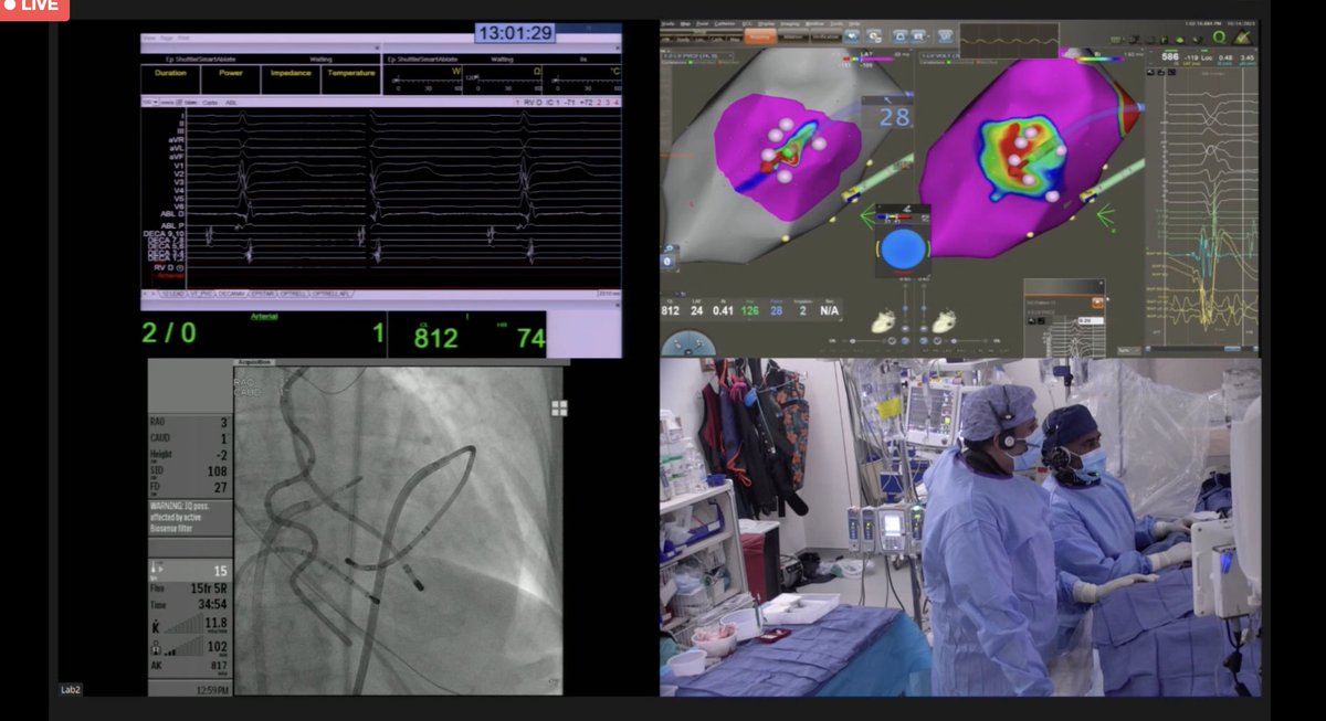 Amazing showcase of #QDot microelectrodes and thermocouples to #AblateVT @VTSymposium @BiosenseWebster #epeeps #mycompany @laurenbjerke @amychas_ep