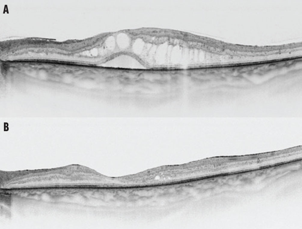 The role of #vitrectomy for #diabeticmacularedema is controversial because studies show anatomical but not functional improvement; however, those results may be due to patient selection criteria. bit.ly/3PUZO4a