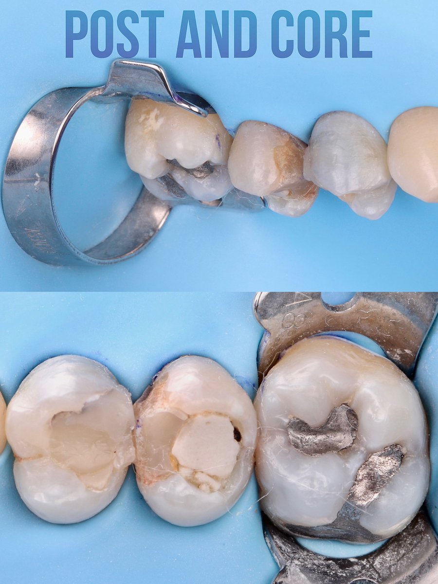saud_mu3's tweet photo. This case has been referred to me for the  post &amp; core buildup for tooth number 14 , 15 .

With an indirect prosthesis “crown” to be placed later.

#dentist #dentaloffice #dentalstudents #dentalmorphologylab #dentista #dentistryworld #dentistrylove https://t.co/oTp6WTS8e8