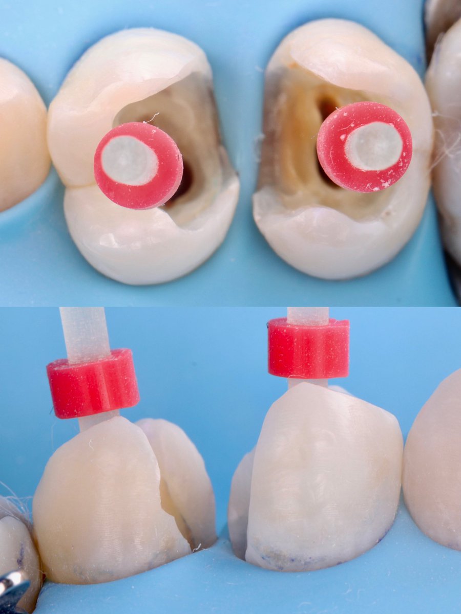 saud_mu3's tweet photo. This case has been referred to me for the  post &amp; core buildup for tooth number 14 , 15 .

With an indirect prosthesis “crown” to be placed later.

#dentist #dentaloffice #dentalstudents #dentalmorphologylab #dentista #dentistryworld #dentistrylove https://t.co/oTp6WTS8e8