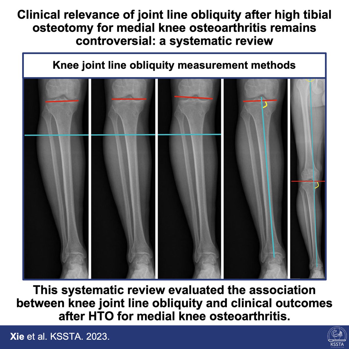 KSSTA's tweet photo. https://t.co/MmDLZ0elvh
Read the latest evidence about the association between knee joint line obliquity and clinical outcomes after HTO for medial knee osteoarthritis.
#osteotomy #jointline #knee #systematicreview #hto #osteoarthritis #tka https://t.co/jlRVqVxxB4