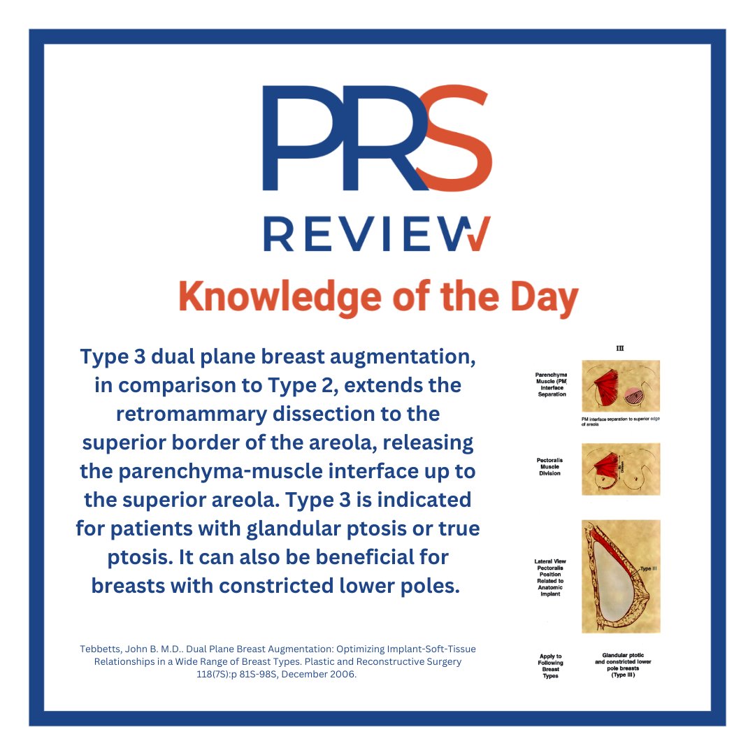 prsreview's tweet photo. Dual Plane Breast Augmentation
#prsreview #breastaugmentation #breastsurgery #dualplanebreastaugmentation #dualplane #cosmeticsurgery #aestheticsurgery #plasticsurgery #reconstructivesurgery #surgicaleducation #medicaleducation #meded #plasticsurgeon #surgery https://t.co/2MmhaTFlv2