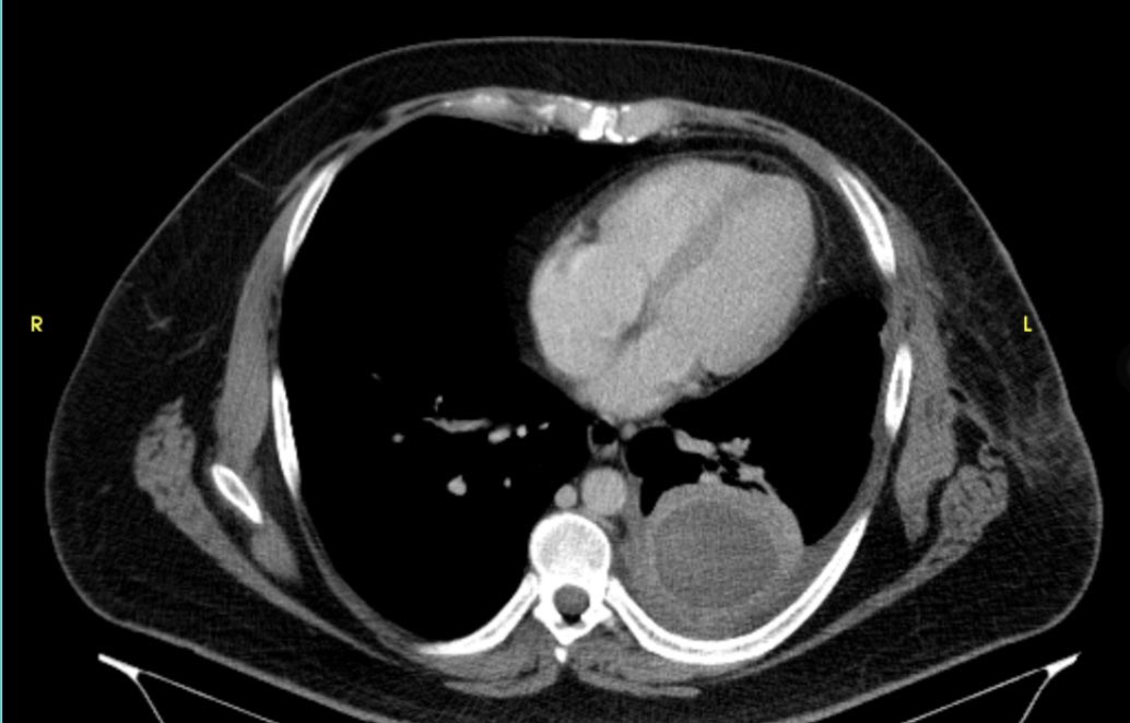 DrFaican's tweet photo. Patient with previous surgery for empyema, after a multidisciplinary meeting, percutaneous drainage with ultrasonographic guidance was performed. #radiology #MedRed https://t.co/jhcb6uLnB8