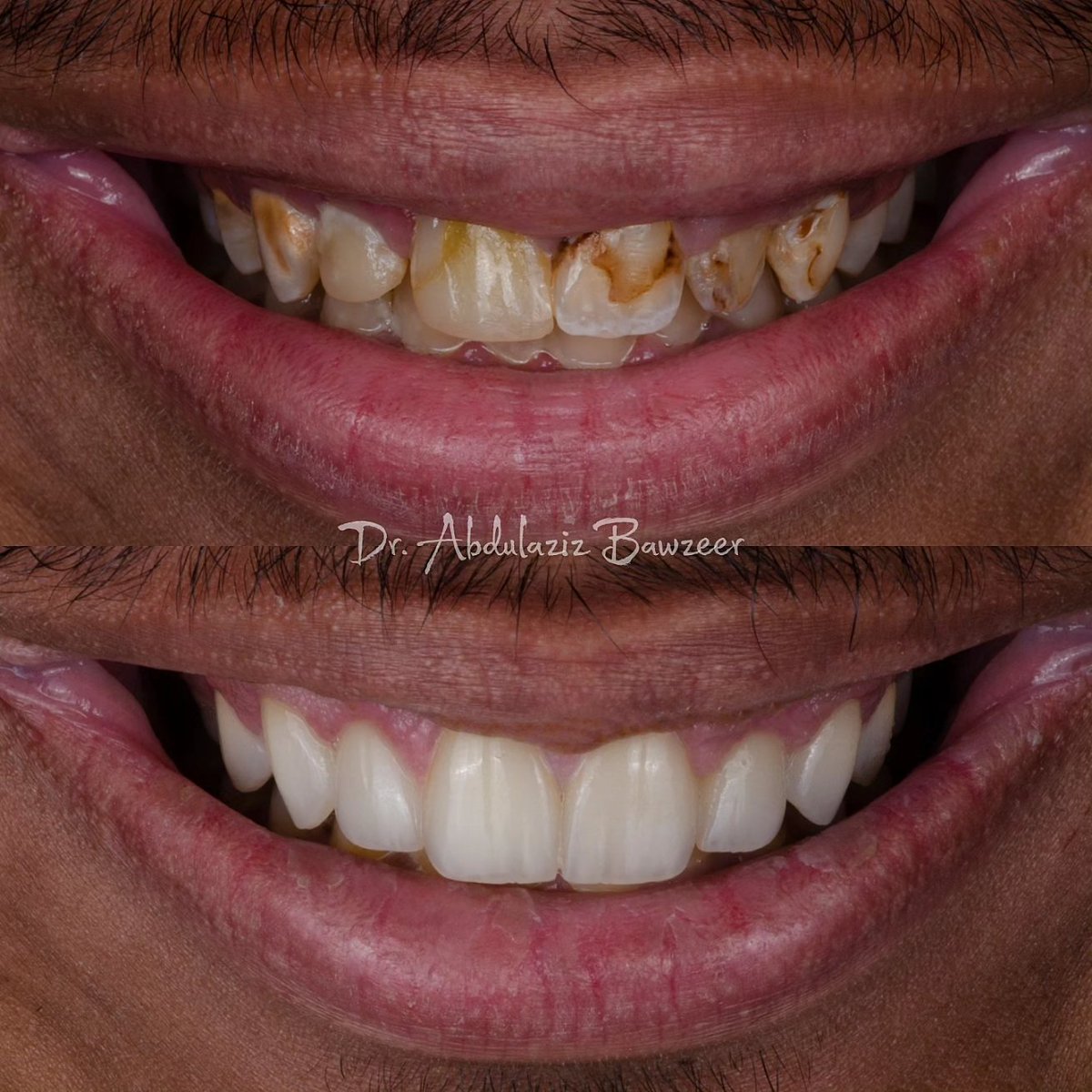 Aziz_Bawzeer's tweet photo. علاج وتجميل الاسنان لمراجعي العزيز وان شاء الله تكون ابتسامته نقطة تحول في حياته للأفضل 🙌🏻

Smile makeover 
E-max crowns and veneers https://t.co/Q0xgSmJcx4