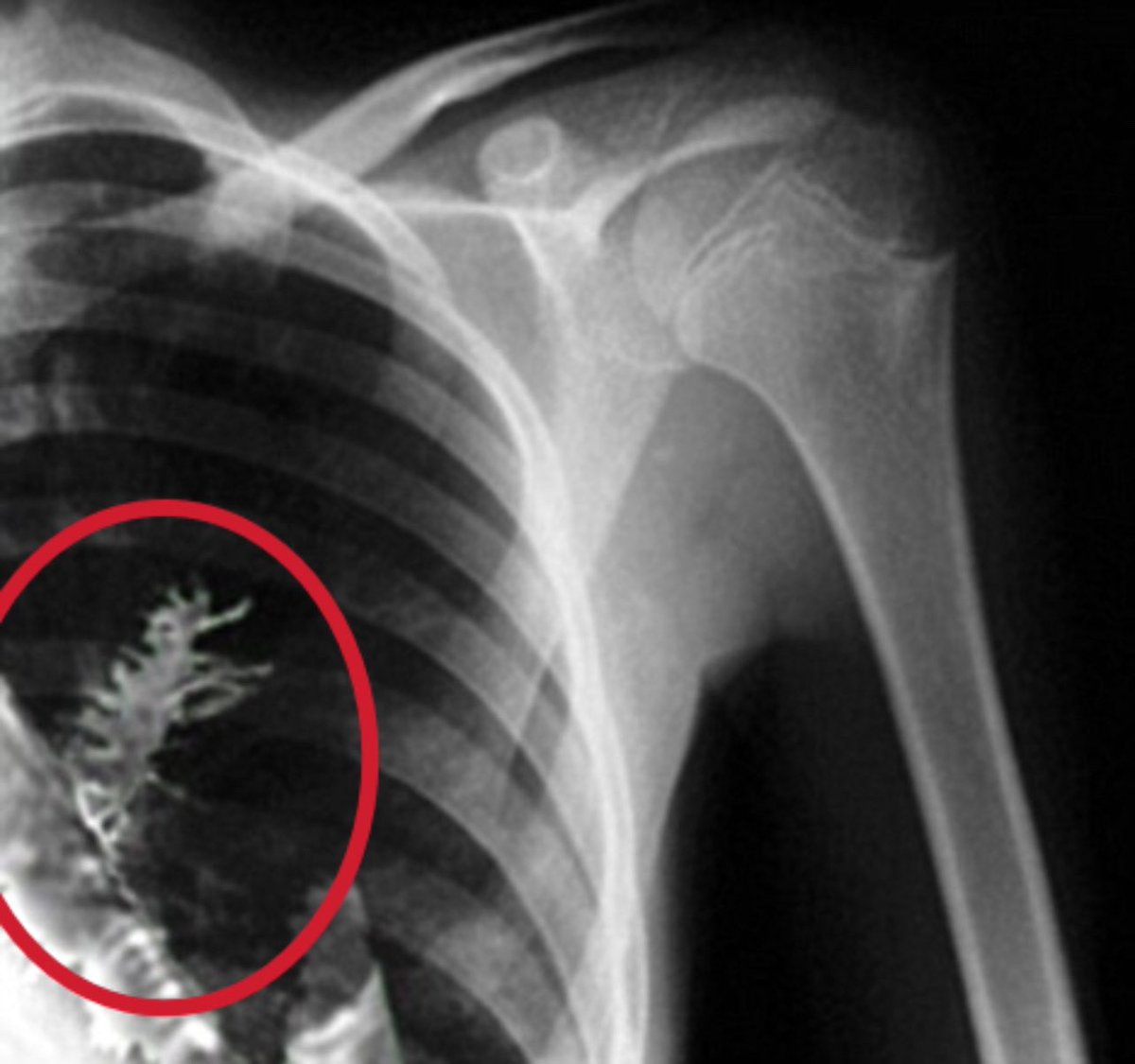 Kadeesayong's tweet image. ในปี 2009 หนุ่มรัสเซียอายุ 28 ไปหาหมอหลังไอเป็นเลือด รู้สึกเจ็บหน้าอกจนแทบทนไม่ไหว ในตอนแรกหมอเห็นสิ่งแปลกปลอมในปอดก็คิดว่าเป็นมะเร็งก็เลยรีบทำการผ่าตัดเอาเนื้อร้ายออก แต่พอลงมีดกรีดก็ต้องตกตะลึงเมื่อสิ่งที่พบในปอดมันคือ ต้นสนขนาด 5 ซม. !