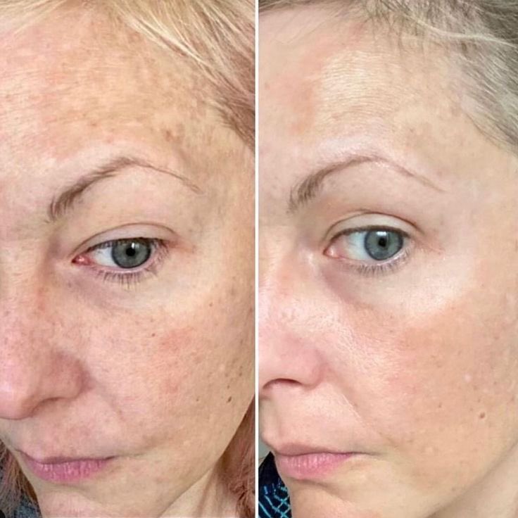 ConniePRINCIPA2's tweet photo. New Upgraded MD Procell Therapies services offered for hair restoration, stretch marks, wrinkles, pigmentation, acne scaring, surgical incision scar reduction and more. https://t.co/el8nZpoEgL https://t.co/LAe1jAh6TI
