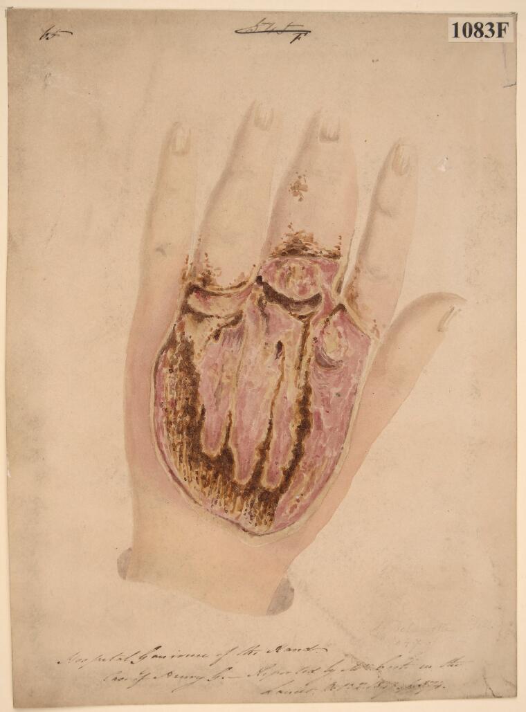 OldOpTheatre's tweet photo. It's #GlobalHandwashing Day! 🧼
We now know that handwashing is key to stopping germs from spreading, but one of the first Victorian breakthroughs before widespread handwashing was the introduction of antiseptics like carbolic acid.
Read more below:
👉 https://t.co/lWICvNueSp https://t.co/vMFnoRX6aW