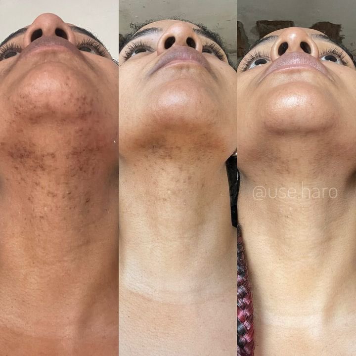 use_haro's tweet photo. Evolução incrível no clareamento de manchas de foliculite da haríssima jhenifer.quirino.5 🧡 
Essa é a resposta quando dizem que cosméticos naturais não funcionam 🤌🏼
Seus produtos estão te aguardando em nossas plataformas! 
Acesse https://t.co/6boQDZPA2w ou https://t.co/wDYL4ofOfA e garanta os melhores cosméticos de autocuidado 🥰  #sabonetenatural #clareamentodapele