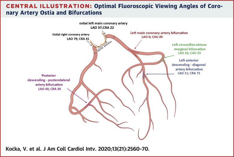 Best bifurcation angles. Several of these can’t be achieved on table though.