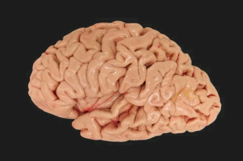 BiogenBR's tweet photo. NOVO ATLAS DO CÉREBRO HUMANO É O MAIS DETALHADO QUE JÁ VIMOS

DOI: 10.1126/science.ade9516
Credibilidade: 999
#Cérebro

Estamos mais perto do que nunca de mapear todo o cérebro ao nível microscópico. Centenas de neurocientistas em todo o mundo caracterizaram recentemente mais de 3.000 tipos de células cerebrais humanas como parte da Rede de Censo Celular da Iniciativa BRAIN do Instituto Nacional de Saúde, publicando quase duas dúzias de artigos em quatro revistas científicas. Essa atenção superconcentrada aos detalhes poderia desvendar muitos mistérios que cercam esse órgão complexo, como o que aconteceu em nossos cérebros para nos distinguir de outros primatas.

“Esta é a primeira descrição detalhada e em grande escala de todos os diferentes tipos de células presentes no cérebro humano”, diz Rebecca Hodge, investigadora assistente do Allen Institute em Seattle, coautora de vários estudos no pacote de papel. A sua esperança é que este atlas cerebral forneça um recurso comunitário para os cientistas explorarem como a grande variedade de células cerebrais contribui para a saúde e a doença.

Mark Mapstone, professor de neurologia da Universidade da Califórnia, Irvine School of Medicine, que não esteve envolvido nestes estudos, comparou os novos dados sobre o cérebro a um guia turístico. “Imagine navegar por uma cidade desconhecida com um mapa de ruas aproximadamente desenhado contendo apenas as principais ruas do centro da cidade, em comparação com navegar pela mesma cidade com um mapa detalhado que se estende além do centro da cidade até os subúrbios e incluindo todas as rodovias, ruas de mão dupla e de mão única. , becos, calçadas, localização de placas de rua e semáforos, limites de velocidade e localização de cafeterias e restaurantes”, afirma. “Clary, este último facilitaria muito a navegação e o entendimento da cidade.” Este primeiro conjunto de estudos mostra três maneiras principais pelas quais o mapa cerebral pode ser usado na biologia e na medicina.

...
https://t.co/qOHUAQoLZx